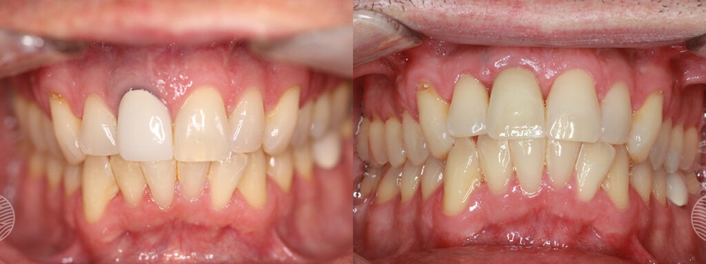 Glacial-Sands_Dental Implants-8